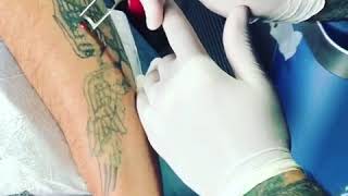 tattoo removal  by customer