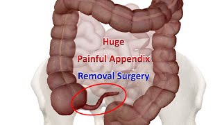 Laparoscopic Appendectomy for Enlarged Appendix Surgical Video | How Surgeons Remove Appendix