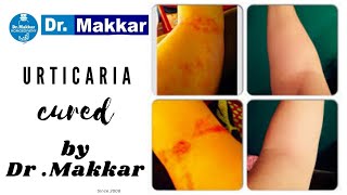 Urticaria homeopathic treatment cure allergic dermatitis patient