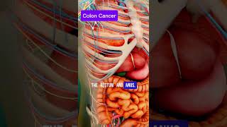 Colon Cancer | The Silent Killer You Must Know About #youtubeshorts #coloncancer #shortsfeed