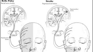 #UMN Fascial Palsy #LacunarStroke #SupranuclearFascialPalsy 🧠