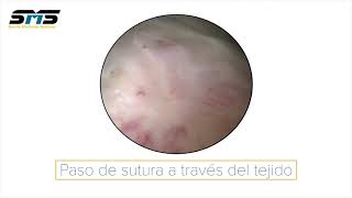 Reparación artroscópica del manguito rotador | Sports Medicine Systems