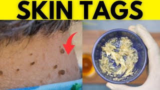 How To Remove Skin Tags In One Night Naturally At Home On Eyelids, Neck And Body