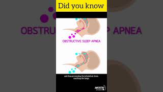 What Is sleep apnea | #shorts #youtubeshorts #knowledge