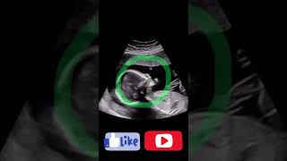 #Baby| Fetus swallowing the amniotic fluid |