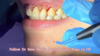 Gum Contouring for gummy smile | DR MAE ABELLA COSMETIC DENTISTRY