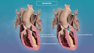 Tell Me More: Hypertrophic Cardiomyopathy