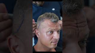 Turkish Hairlines: Sağlık Turizmi gelirlerinin yarısına yakınını saç ekimi oluşturuyor. #shorts