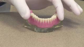 Implant Overdenture or an Implant Retained Denture