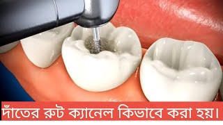 দাঁতের রুট ক্যানেল কিভাবে করা হয়? এবং রুট ক্যানেল এর খরচ কত? Tech Dental