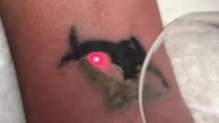 Laser tattoo removal on black wrist tattoo in Raleigh