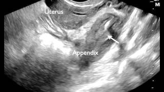 Transvaginal Ultrasound of Appendicitis