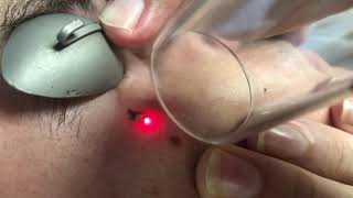 Teardrop tattoo removal on the face