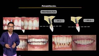 Implantología dental para estudiantes de odontología