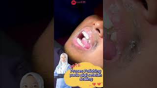 Klinik Siti Pergigian Puncak Jalil #dental #klinikgigi #scaling #polishing