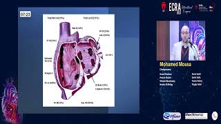 Challenging SVT Tracings   Dr  Mohamed Mousa