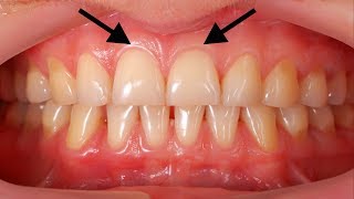 Grow Back Your Receding Gums In 2 Weeks By Only Using These Natural Homemade Remedy