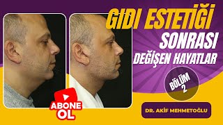 Gıdı estetiği sonrası değişen hayatlar 2 I  DR. AKİF MEHMETOĞLU