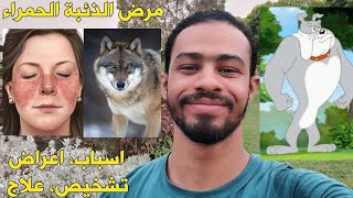 مرض الذئبة الحمراء (اعراض، اسباب، تشخيص، علاج)