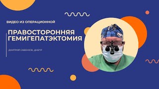 Правосторонняя гемигепатэктомия I Гигантская гемангиома I  Савенков Дмитрий