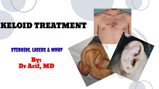 keloid treatment: Steroids, lasers & Mnrf @DrArifMDDermatologist #keloidtreatment