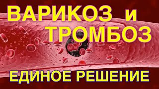 Три причины Варикоза и Тромбоза. Единое решение.