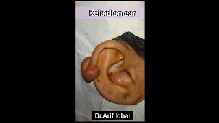 Keloid removal surgery from the ear by Dr Arif Iqbal