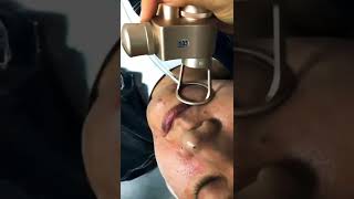 Fractional Co2 laser Skin Resurfacing Treatment