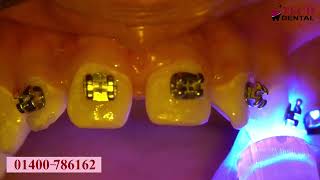 ফাঁকা দাঁতের ব্রেসেস চিকিৎসা ।। Tech Dental