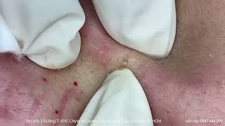 Big Cystic Acne Blackheads Extraction Blackheads & Milia, Whiteheads Removal Pimple Popping