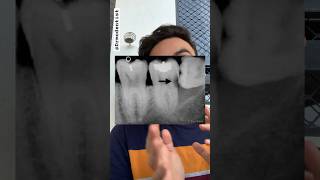 Impacted Wisdom Tooth And Cavity formed! #cavityprevention #cavityfilling #toothcavity #dentalxray