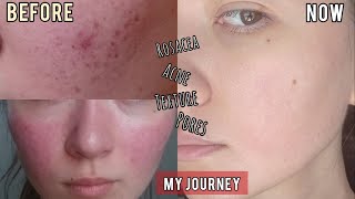 Fixing My Skin Issues | Rosacea, Acne, Dry, Sensitive Skin 修復我的皮膚問題 | 玫瑰斑、青春痘、乾性皮膚、敏感性皮膚 (中英文字幕)