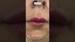 Dr. Alejandro Acuña | RELLENO DE LABIOS CON ÁCIDO HIALURÓNICO