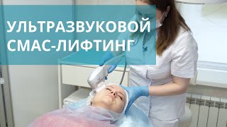 🌟 Ультразвуковой SMAS-лифтинг на аппарате Ультраформер — методика HIFU. СМАС-лифтинг Ультраформер.