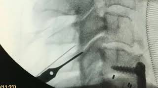 Fijación Cervical Percutánea Posterior