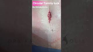 Belt tummy tuck