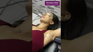 Hair Removal Treatment, Laser Hair Removal #navadiyaskincare