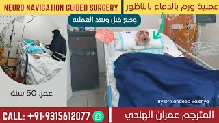 عملية استئصال ورم بالدماغ|Neuro Navigation Guided Surgery|ورم خبيث بالمخ|أفضل دكتور جملة عصبية