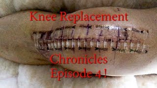 Episode 4 Knee Replacement Chronicles, Oh the Headaches