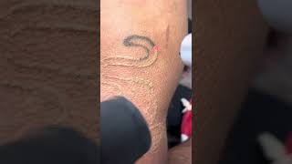 Laser tattoo removal on black Panther tattoo