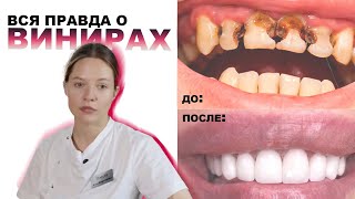 👩‍⚕️вся правда о винирах от стоматолога