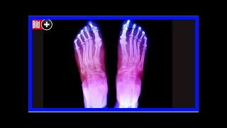 Hallux valgus, knick-senkfuß & morton neurom - die 13 größten gefahren für ihre füße