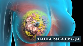 Типы рака груди. Как правильно лечить.