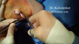 Cyst on the bottom of the foot surgically removed by a Podiatrist - Foot Surgeon in Orange County