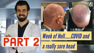 Part 2: Cinik Clinic: Turkey: Hair transplant :  FIRST TEN DAYS