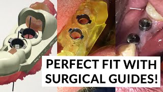 What are surgical Guides? - Modern Dentistry in Mexico