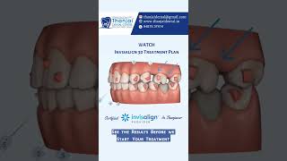 Aligners Treatment Plan|3D Simulation | See Results before we start the Treatment | Invisalign Steps