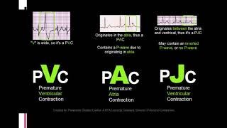 EKG itu Gampang Sesi 4(Latihan Tentang Aritmia, level pemula)