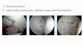 Arthroscopic Anatomy of the Hip Joint