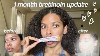 1-Month Tretinoin Update: Before & After Transformation + Honest Experience!